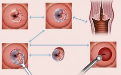 宫颈炎和宫颈糜烂还傻傻分不清吗？